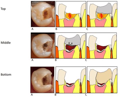 Vital Pulp Treatment Pocket Dentistry