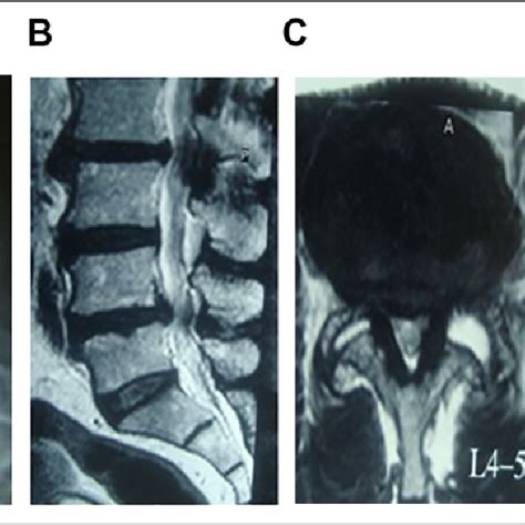 A Dynamic Lumbar Spine X Ray With Instability And Listhesis At L4 L5