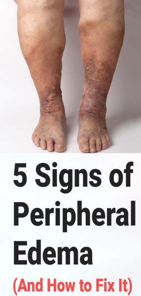 5 Signs Of Peripheral Edema And How To Fix It