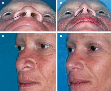 A Simplified Approach To Alar Base Reduction Jama Facial Plastic