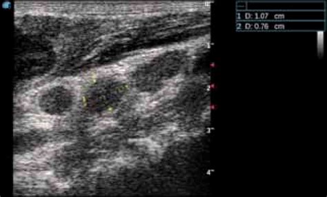 Figure 1 From Ultrasonography Of Head And Neck Lymph Nodes Performed By