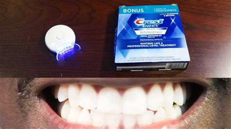 Teeth Treat Professional At Home Teeth Whitening Kit Groupon Review