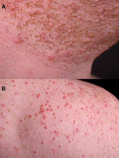 Common Condition With Uncommon Cause Fungal Folliculitis In