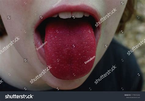 Bright Red Tongue Strawberry Tongue Stock Photo 1179572242 Shutterstock