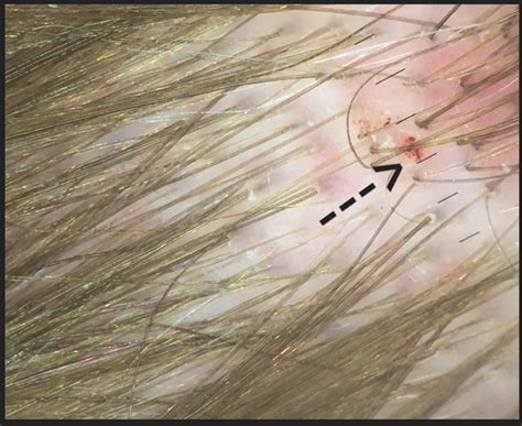 Red Spots On Scalp Thinning Hair How Does A Doctor Locate Melanoma On