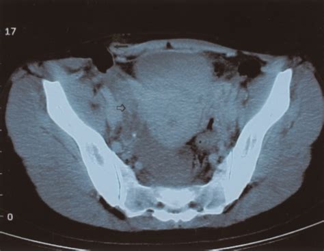 Figure 1laparoscopic Repair Of Blunt Traumatic Anterior Abdominal Wall