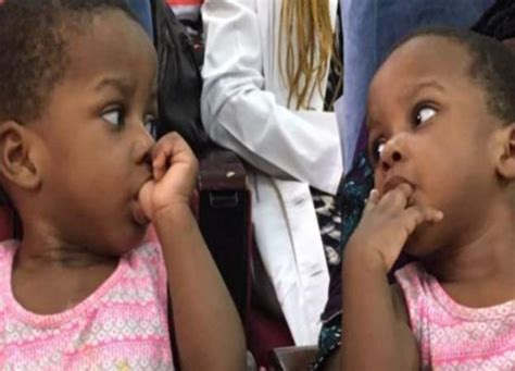 78 Doctors Successfully Separate One Year Old Nigerian Conjoined Twins