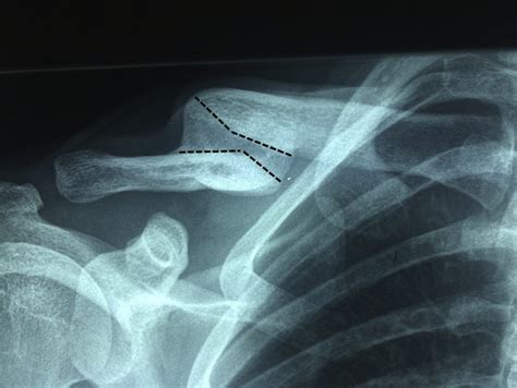 Operative Management Of Clavicular Malunion In Midshaft Clavicular