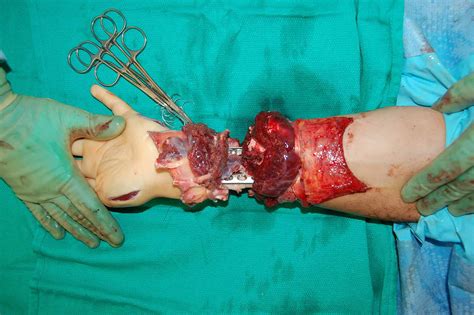 Cureus Self Amputation Of The Upper Extremity A Case Report And