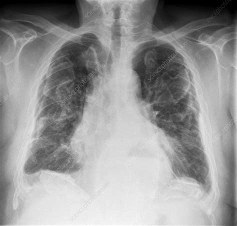 Asbestosis X Ray Stock Image C0177143 Science Photo Library