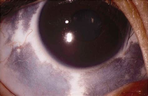 Discoloration Ofaround The Eye Visual Diagnosis And Treatment In