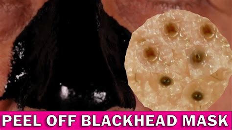 Blackhead Removal Under A Microscope Youtube