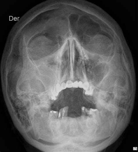 Sinusitis Aguda En Mnp Imagenes De Medicos Imagenologia Radiología