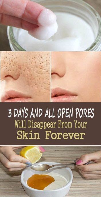 How To Get Rid Of Enlarged Pores Naturally In 2020 Skin Treatments Face Mask For Pores
