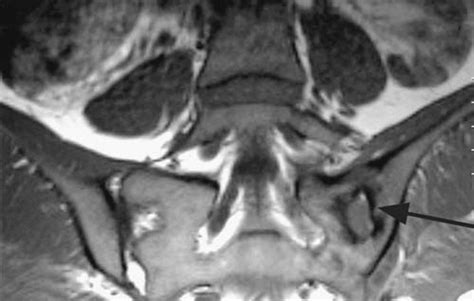 Mri Of The Sacroiliac Joint Showing The Focus Of Infection In The Left