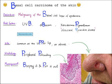 Basal Cell Carcinoma Mnemonic