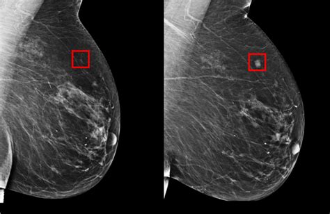 A Deep Learning Mammography Based Model For Improved Breast Cancer Risk
