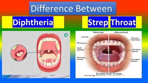 Diphtheria Vs Strep Throat Youtube