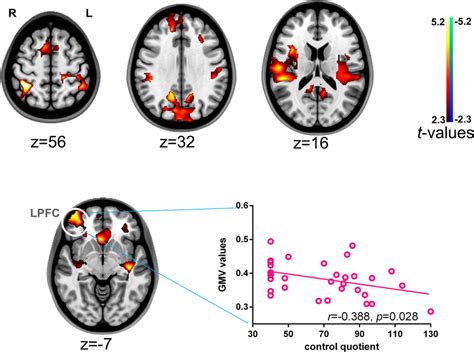 Gray Matter Alterations In Patients With Rolandic Epilepsy Group