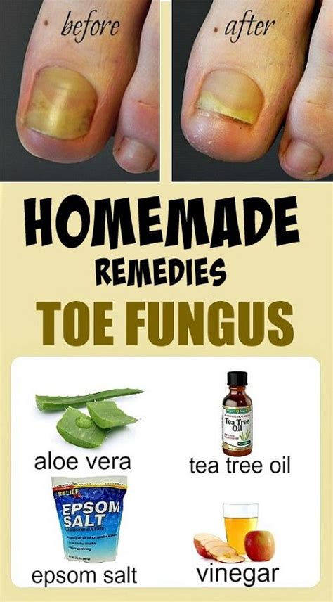 Home Remedies For Toe Fungus Toe Fungus Toenail Fungus Remedies