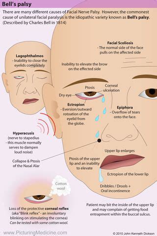 Bell S Palsy Facial Palsy Syndromes Bells Palsy Medicine