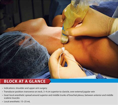 Ultrasound Guided Interscalene Brachial Plexus Block Anesthesia Key