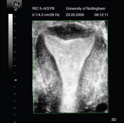 3d Ultrasound In Gynecology And Reproductive Medicine Lucy Coyne