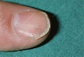 Splinter haemorrhage on fingernail in endocarditis - Stock Image - M172 ...