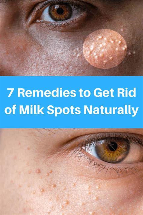 7 Remedies To Get Rid Of Milk Spots Naturally Natural Acne Remedies