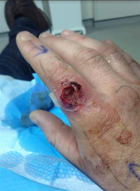 Man Nearly Loses Finger After Being Bitten By Uk Spider Uk