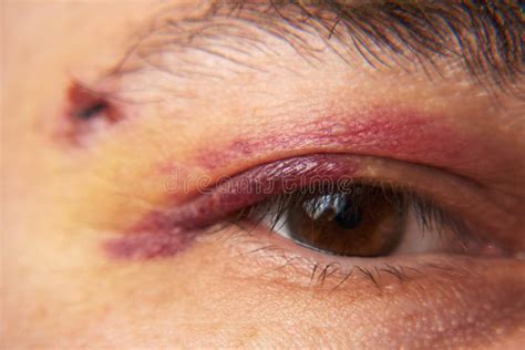 Close View Of A Bruise Near The Eye The Face Of A Man With A Hematoma Stock Photo Image Of