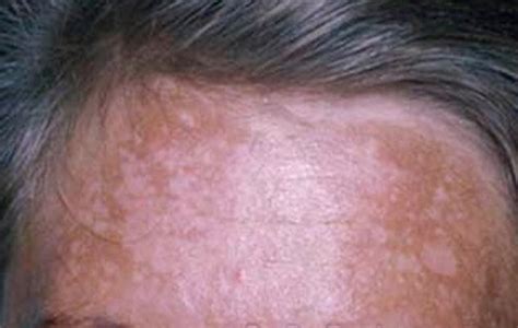 Melasma Chloasma Pictures Causes Symptoms And Treatment