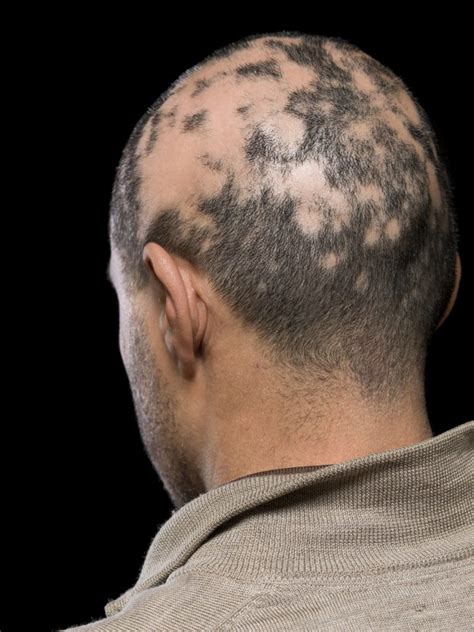 Alopecia Areata Treatment U S Dermatology Partners