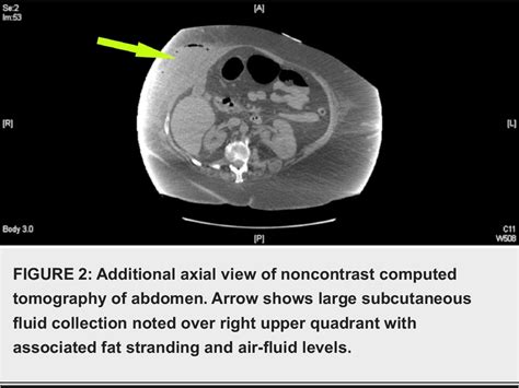 Figure 2 From Abdominal Wall Abscess Secondary To Cholecystocutaneous