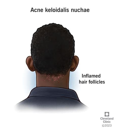 Acne Keloidalis Nuchae What It Is Causes And Treatment