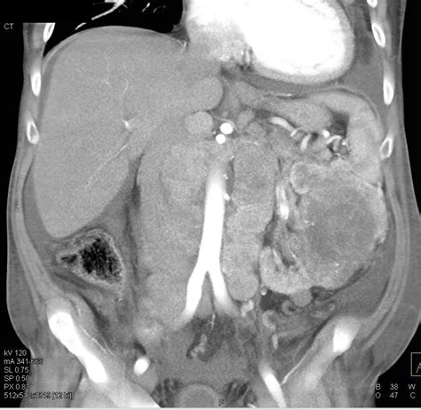 Mediastinal Adenopathy Due To Metastatic Renal Cell Carcinoma Chest