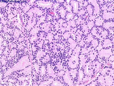 Gleason Pattern 4 Human Pathology