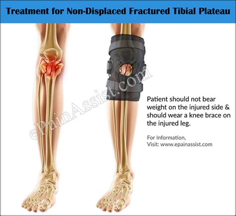 Displaced Tibial Plateau Fracture Recovery