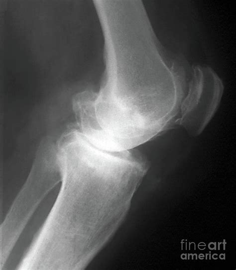 Osteoarthritis Of The Knee Photograph By Zephyrscience Photo Library