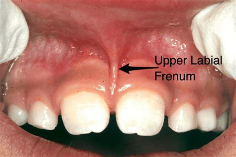 What Is A Frenectomy In Dentistry Archwired