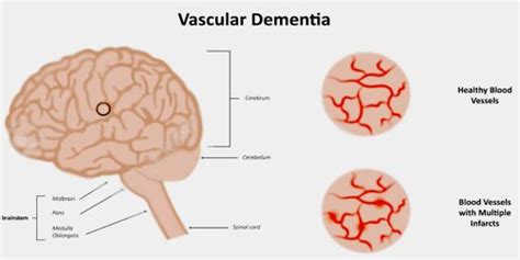 Vascular Dementia Assignment Point