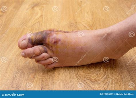 Swollen Injured Male Limb On The Left Foot With Hematoma When A Heavy