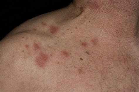Eczema On The Neck Pictures 12 Photos And Images