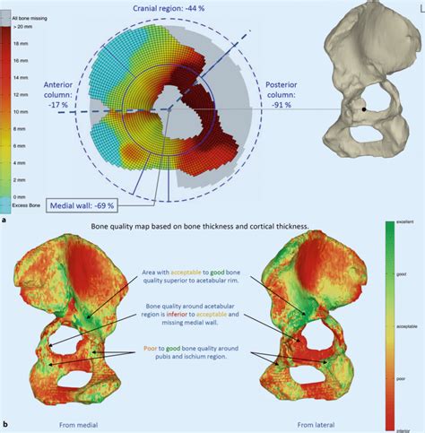 Acetabular Defect Classification In Times Of 3d Imaging And Patient
