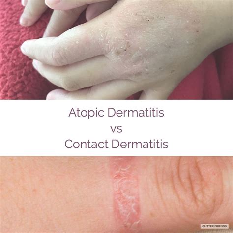 Occurs As Result Of These Conditions Acute Eczema Itchy Blisters On
