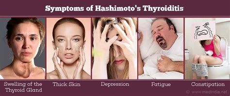 Hashimotos Disease Symptoms Causes And Treatment Santripty