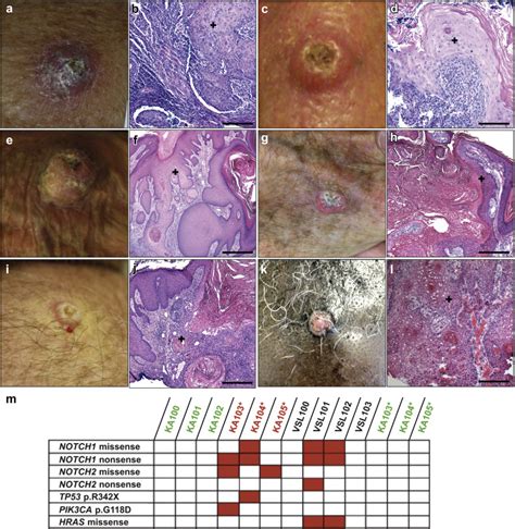 Keratoacanthoma Shares Driver Mutations With Cutaneous Squamous Cell