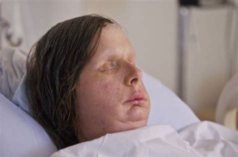 Woman Mauled By A Chimpanzee Reveals Her Full Face Transplant