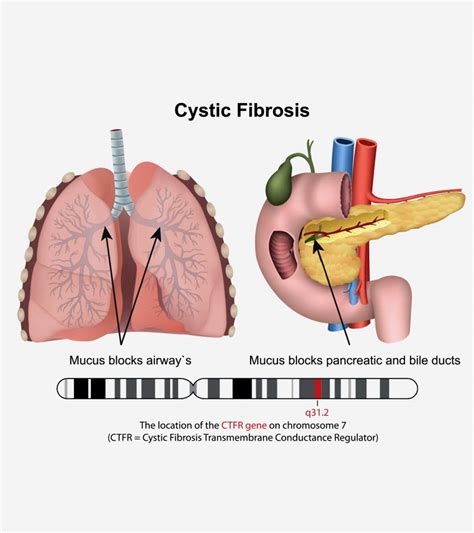 Cystic Fibrosis In Babies Symptoms Causes And Treatment