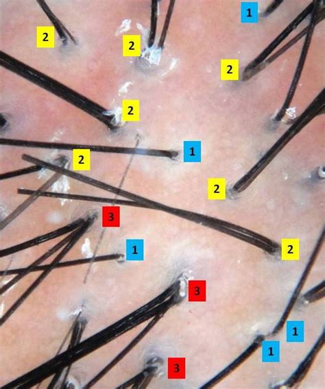 18 Multiple Hairs In One Follicle Images Onurcanaydogmus